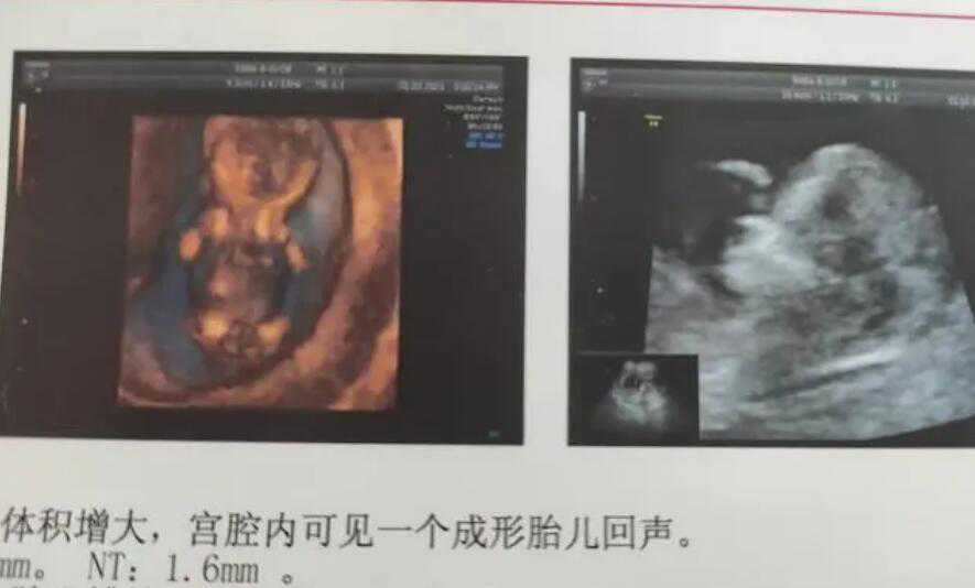 广州借卵代怀医院 广州做一次试管婴儿要准备多少钱 ‘*彩超报告看男女*’